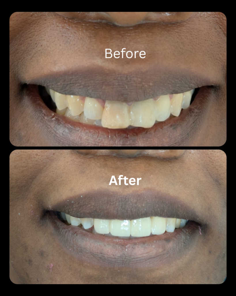 teeth whitening gurgaon