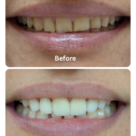 laser dental bleaching