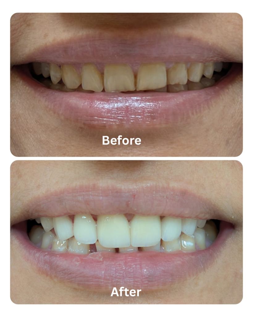 laser dental bleaching