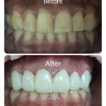 teeth whitening dentist