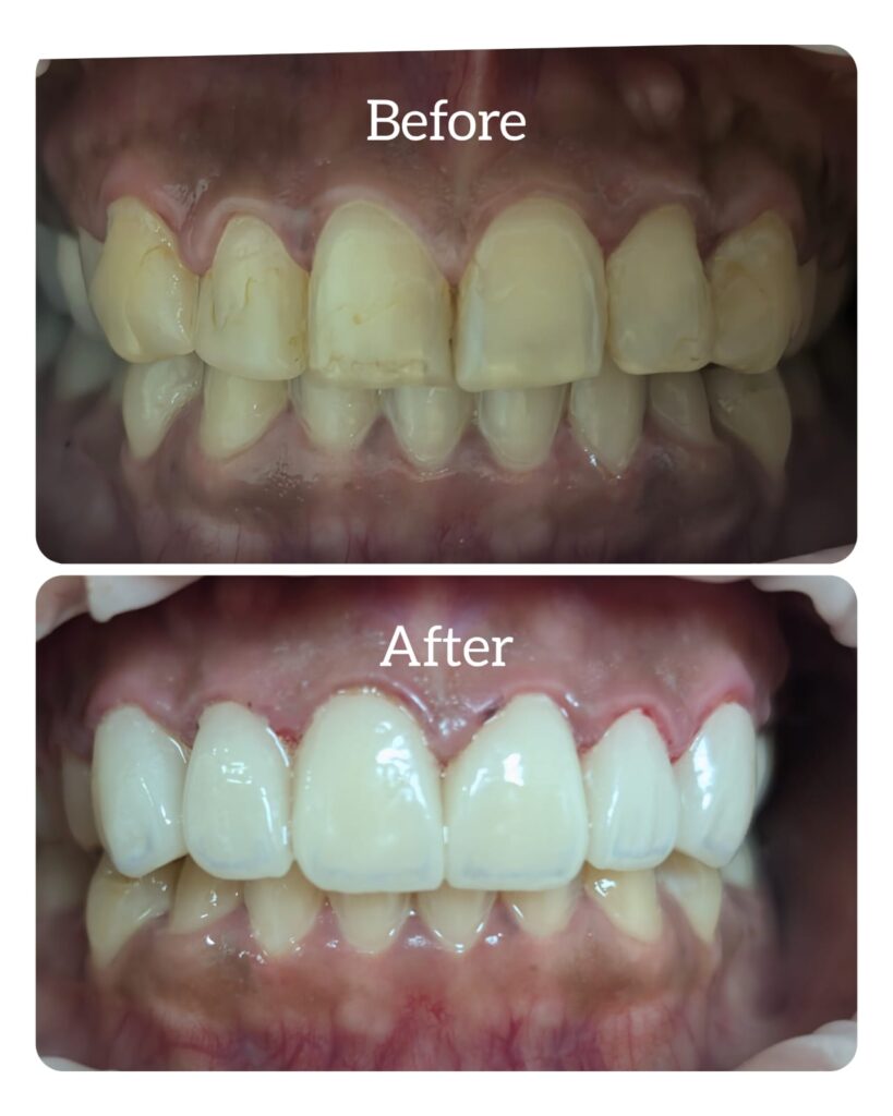 teeth whitening dentist