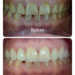 painless teeth whitening