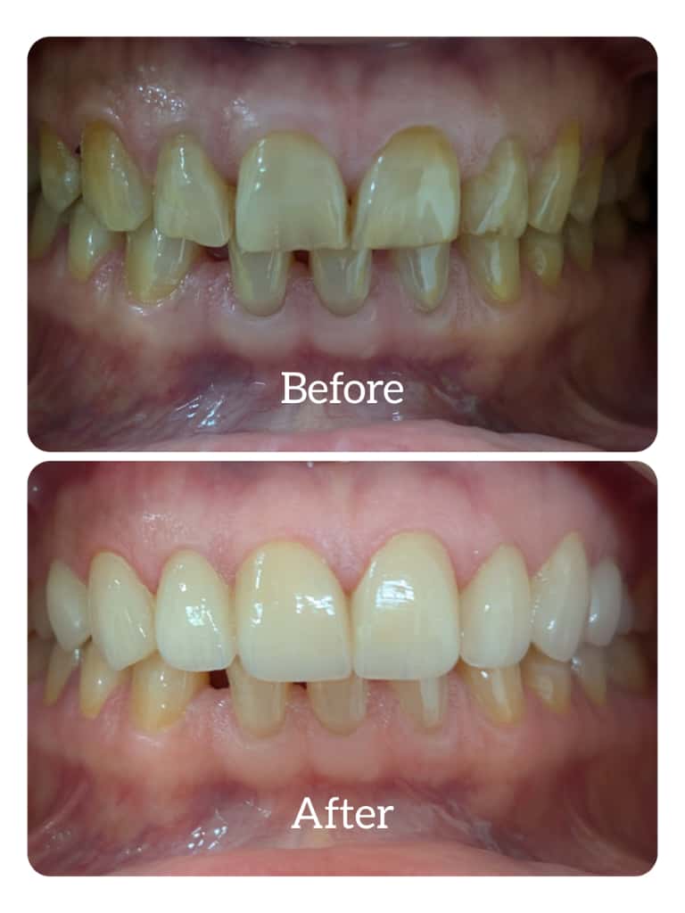 painless teeth whitening