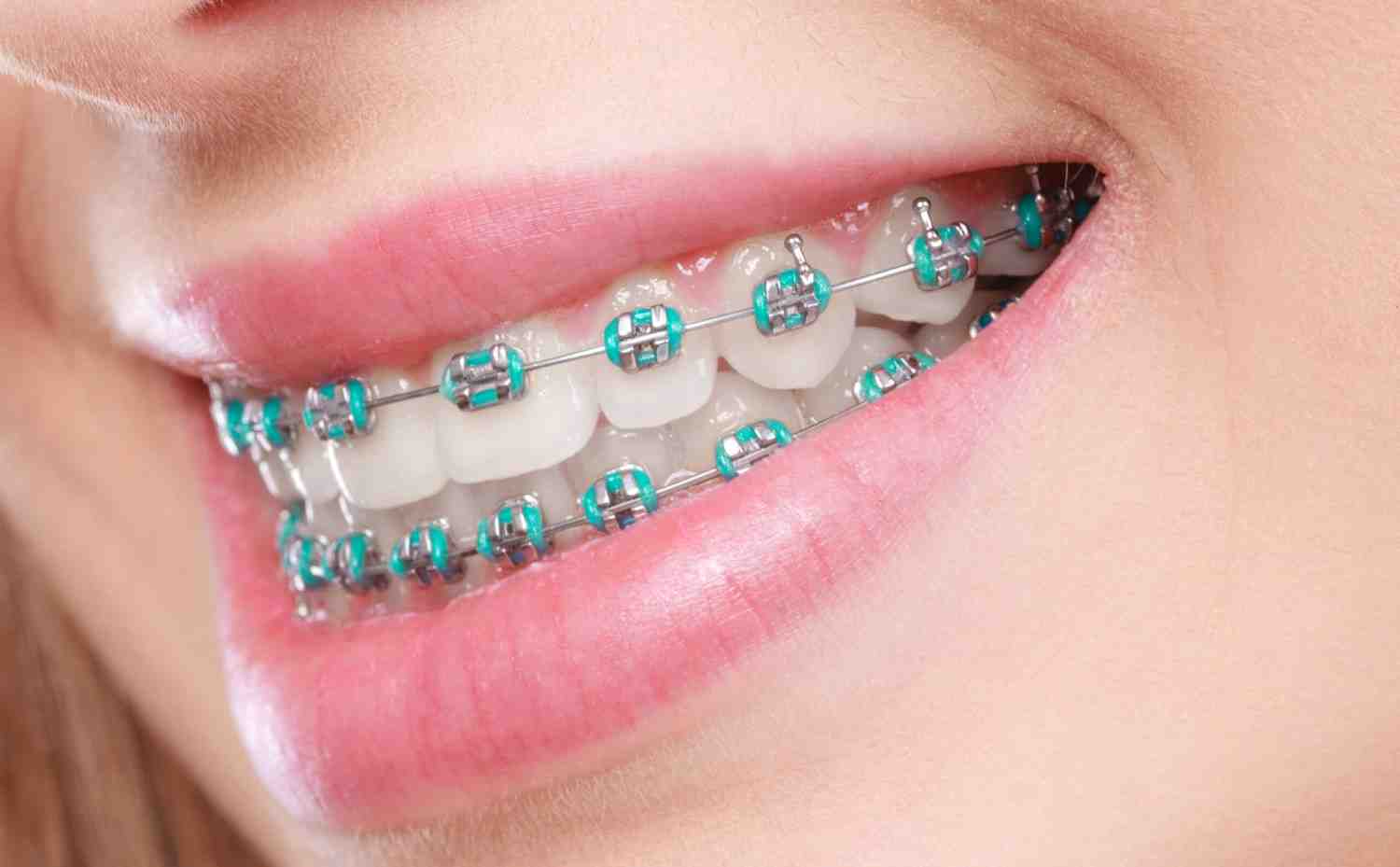 braces1