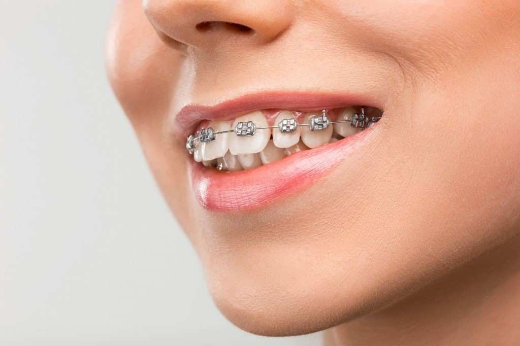 braces2