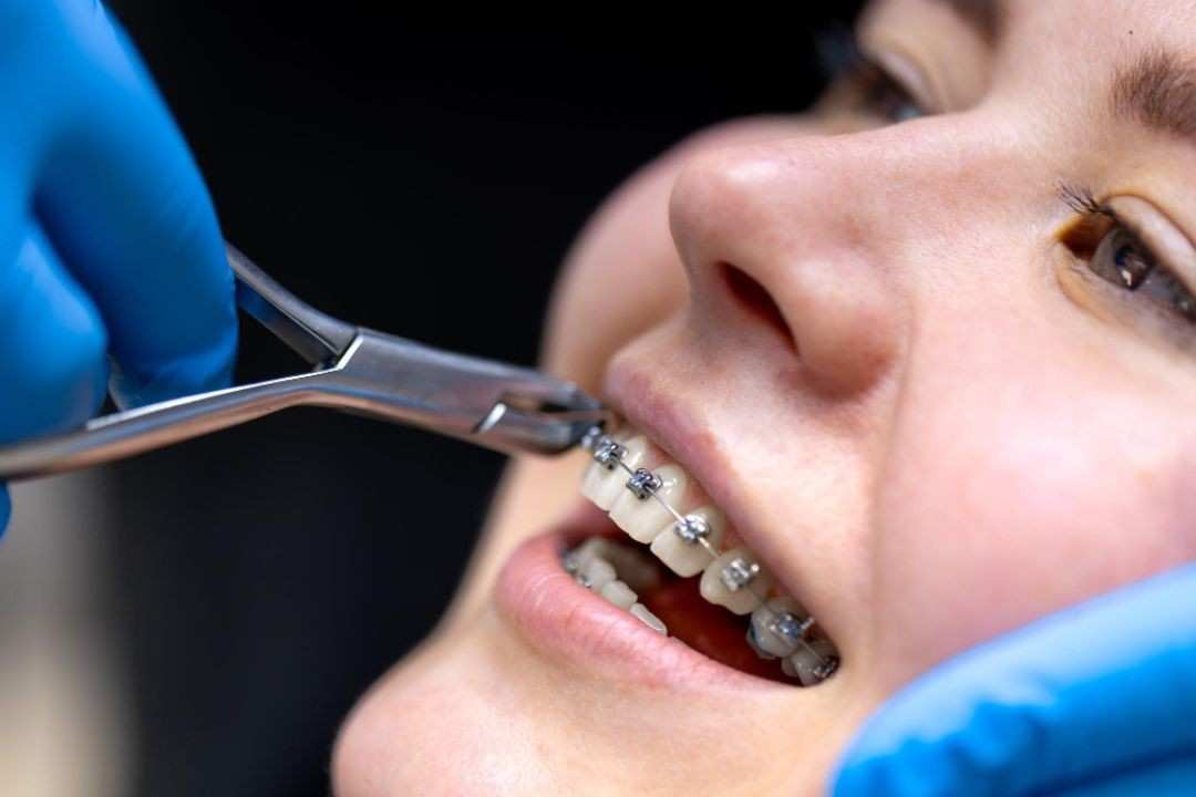 braces4