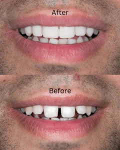 Before-2