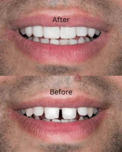Before-6