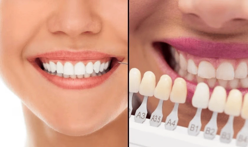 Teeth Whitening Vs Veneers